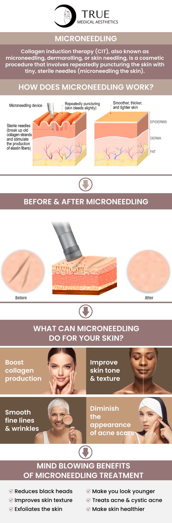 Radiofrequency Microneedling stimulates the body through a natural process to produce stronger, healthier, more youthful skin. It can reduce signs of aging, including fine lines and skin laxity, as well as improve skin tone, texture, and acne scars. Consult Tristen Durkin, RN, and her team at True Medical Aesthetics to restore and rejuvenate your skin with Radiofrequency Microneedling. We are conveniently located at 50 Avon Meadow Lane Avon, CT 06001. For more information, contact us or request an appointment online.