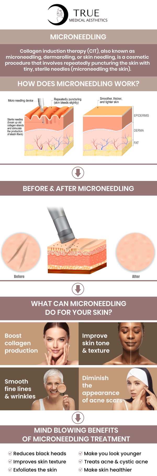 At True Medical Aesthetics, Tristen Durkin, RN, offers microneedling treatments to help improve the appearance of acne scars. This non-invasive procedure stimulates collagen production, promoting skin healing and reducing the visibility of scars over time. With personalized care and advanced techniques, microneedling can smooth uneven skin texture, leaving you with a more even, youthful complexion. For more information, please contact us or schedule an appointment online. We are conveniently located at 50 Avon Meadow Ln, Avon, CT 06001.